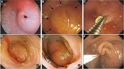 Clinical application of endoscopic diaphragmotomy and dilation in a congenital duodenal diaphragm